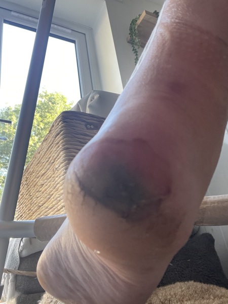 Concerned about heel pressure sore after tibia surgery, should I seek help?