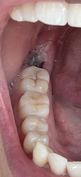 Wisdom tooth???