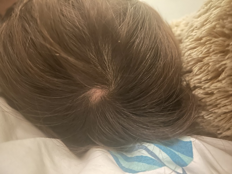 New smooth bald spot on my five-year-old's crown, awaiting GP
