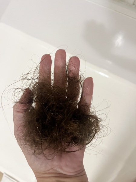 Extreme hair loss - any tips to stop it?