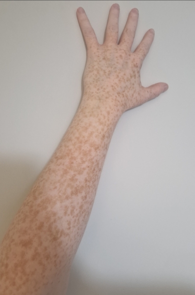 Would you consider laser treatment for larger freckles or try to embrace them?