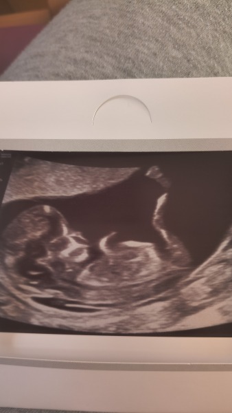Can anyone guess boy or girl from my 12 week scan?