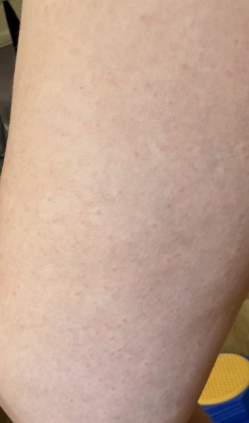 Rash on both thighs spreading down legs.