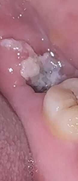 Wisdom tooth removal