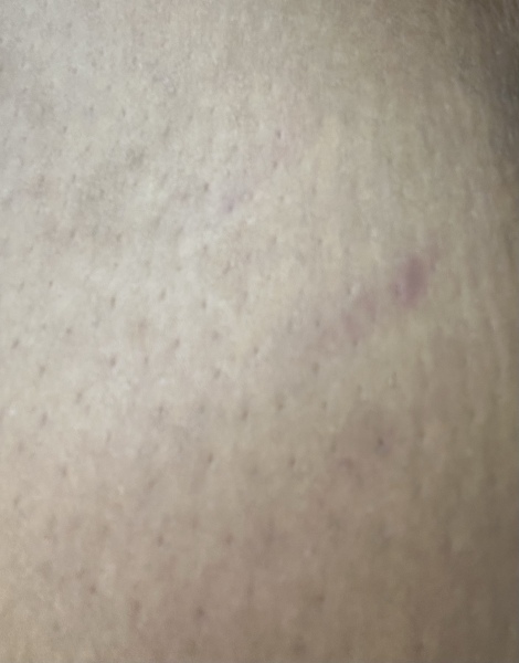 Is this a stretch mark on breast ?