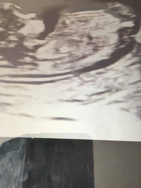 Can anyone point out which part is the nub in this scan?