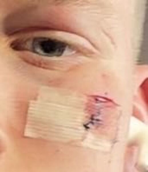 DS split his cheek playing rugby while away with school. Can anyone with first aider knowledge reassure me? Photo attached.