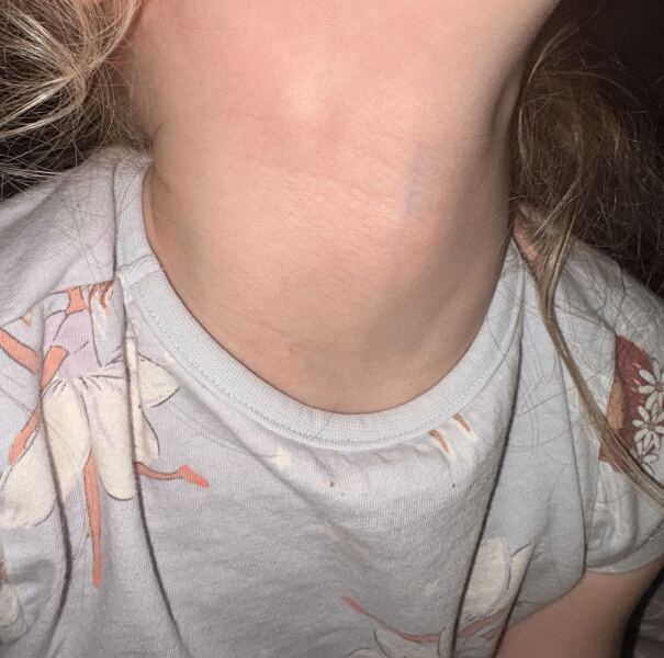 Petrified- 6 year old with 3cm mobile neck lymph node- anyone had similar?