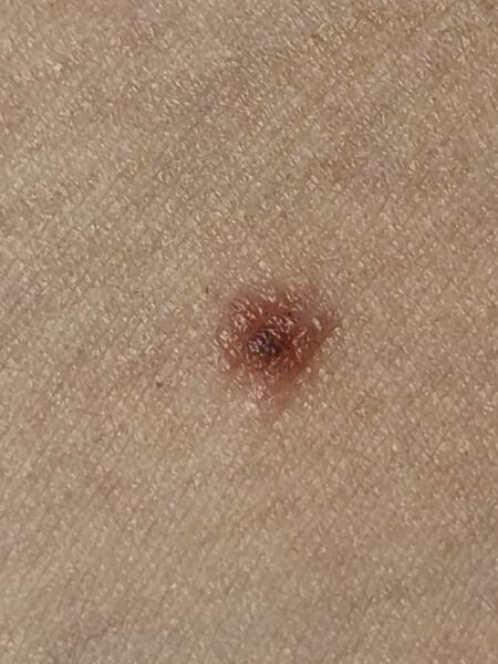 Potential melanoma