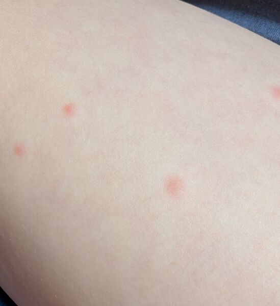 Could my child have chickenpox again, or could it be something else?