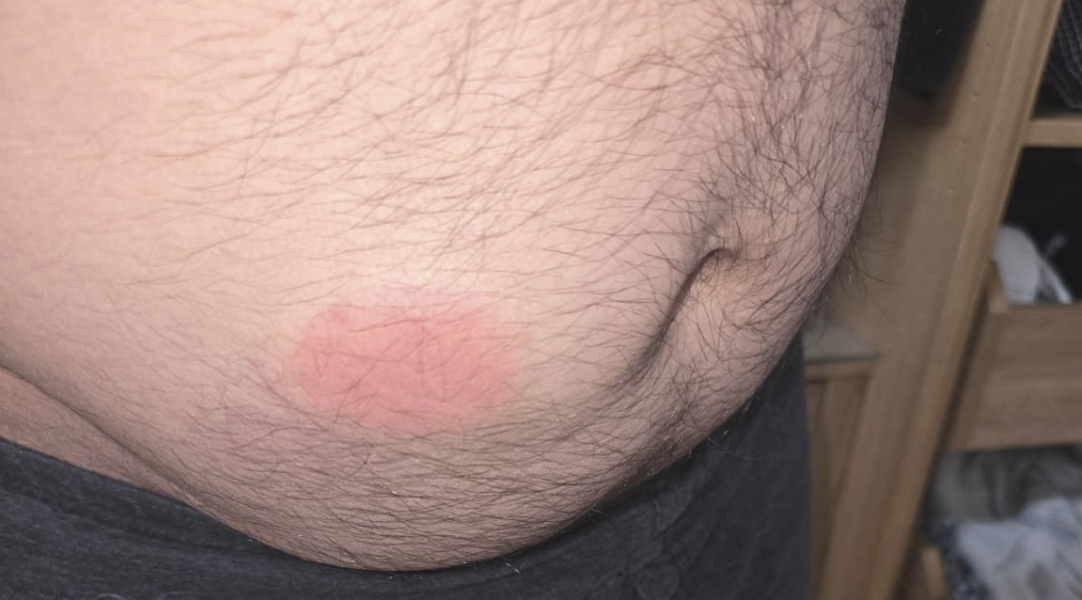 Mounjaro injection site reactions