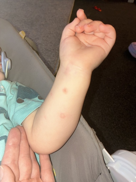 Spots on toddler then had 12 month vaccinations
