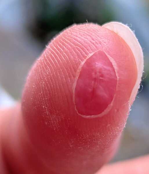 Advice on finger tip injury please.