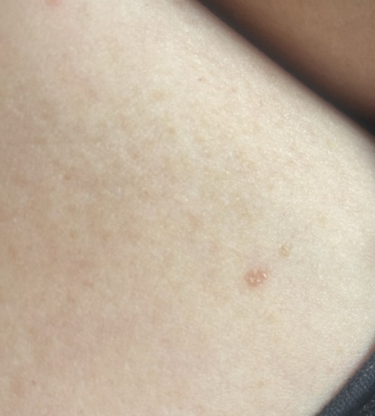 New little spots/bumps inside brown mark in boob ive had for years