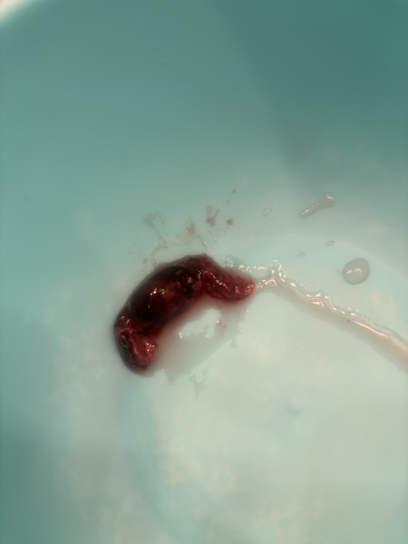 Could this be a miscarriage or another early pregnancy issue?