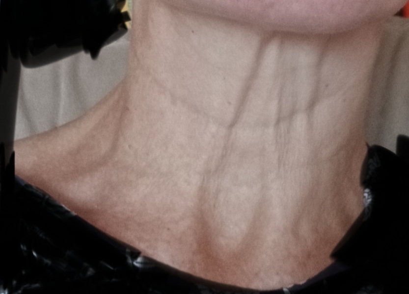 Saggy neck photo!