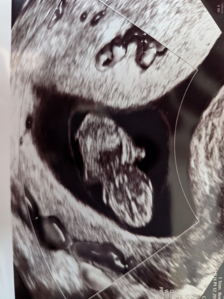 Ultrasound scan questions