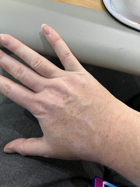 To be shocked by multiple white patches on child’s face after foreign sun exposure