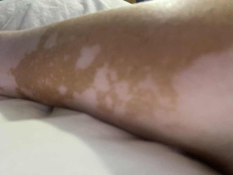 To be shocked by multiple white patches on child’s face after foreign sun exposure