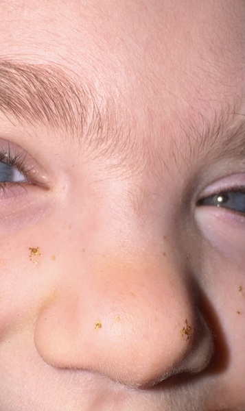 Excess hair on preschool child