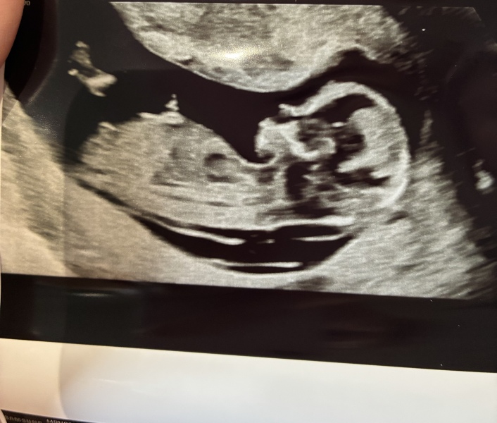 Nub theory wrong at 13 weeks??
