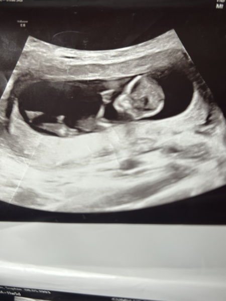 Can anyone help identify the nub in my early scan photos?