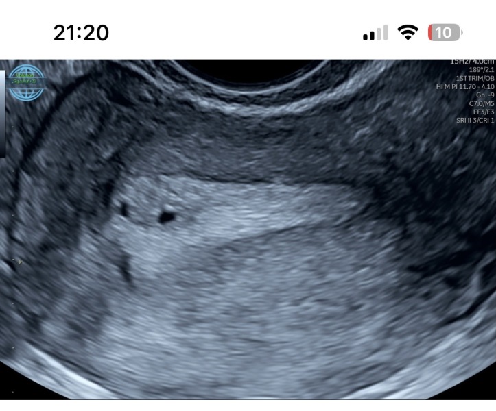 Could a very early pregnancy scan indicate twins at 3 to 4 weeks?