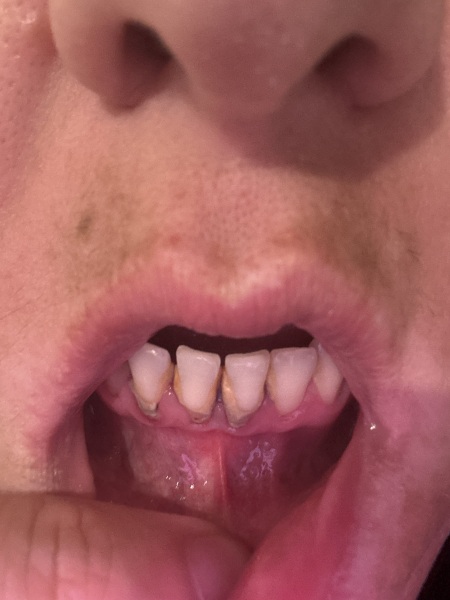 AIBU to worry about dental bone loss after avoiding check-ups?