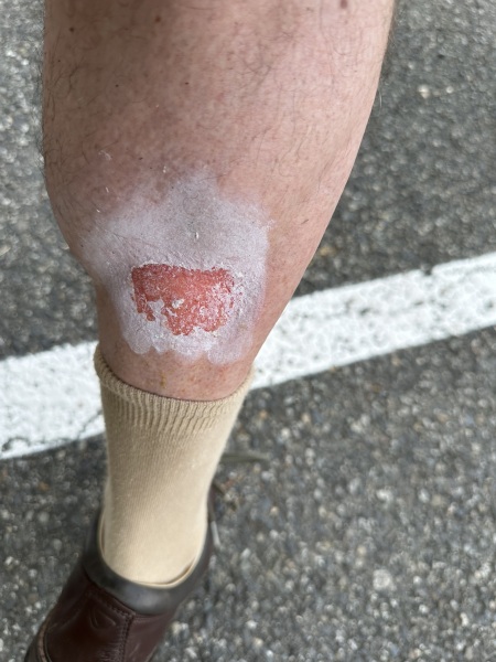 Cyclist. Accidental burn from motorbike exhaust.