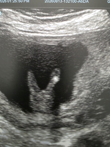 13-week scan: any guesses on whether it’s a boy or girl?
