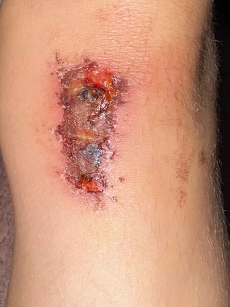 What’s the best way to help dd6 grazed knee heal please?