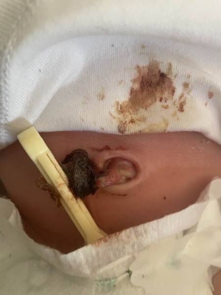Possible infected umbilical cord - graphic pic 🤢