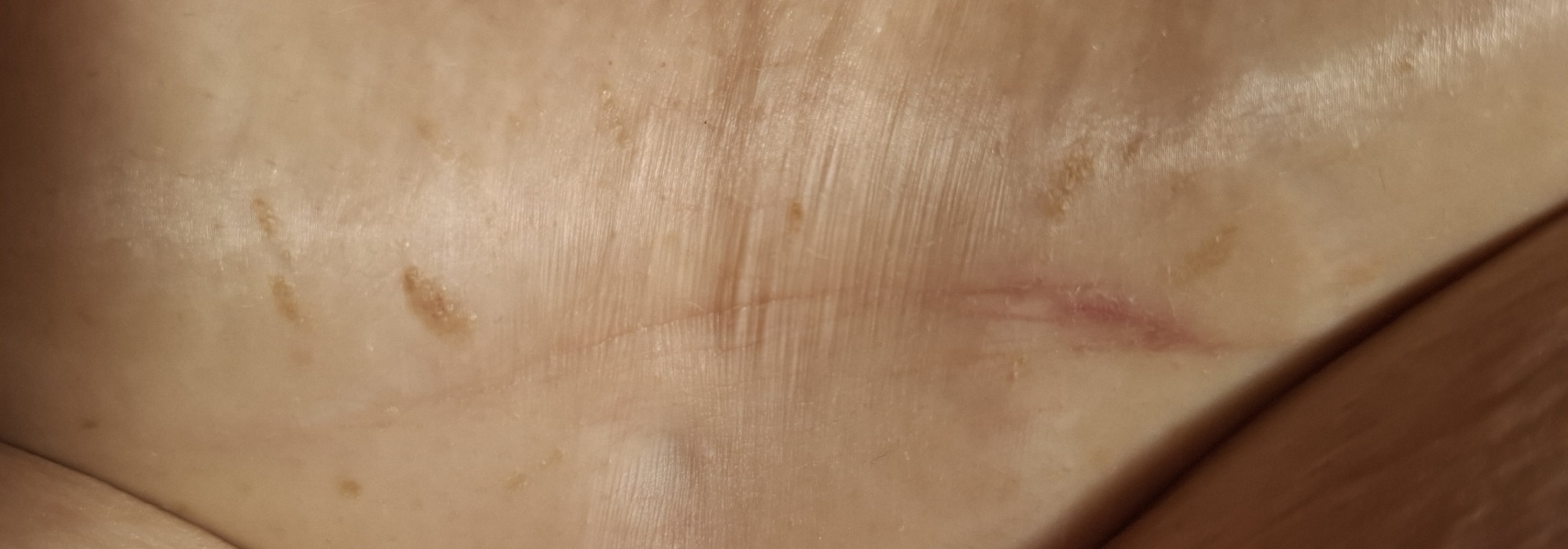 Skin fold issues after weight loss