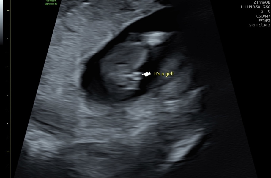 Boy or girl on potty shot ?