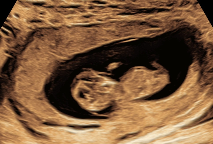 Nub theory - 12 week ultrasound. - guesses please!!