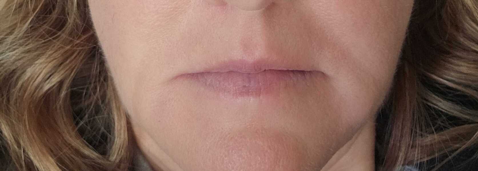 Help with marionette lines