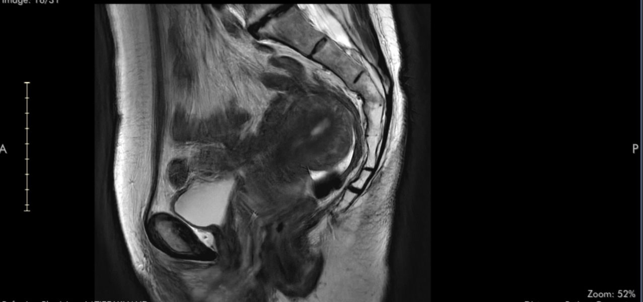 Adenomyosis and retroverted uterus, could this be causing my bowel issues?