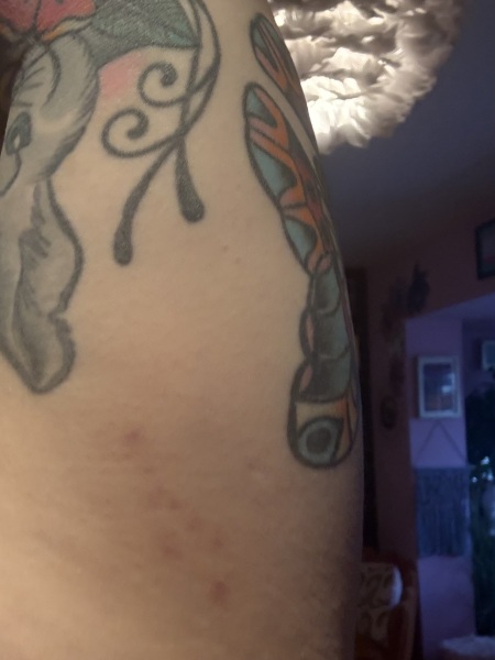 Large painless underarm bruise with history of easy bruising