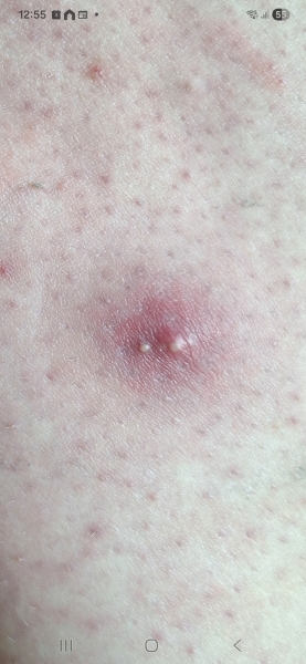 Cyst? Boil? Infected follicle?