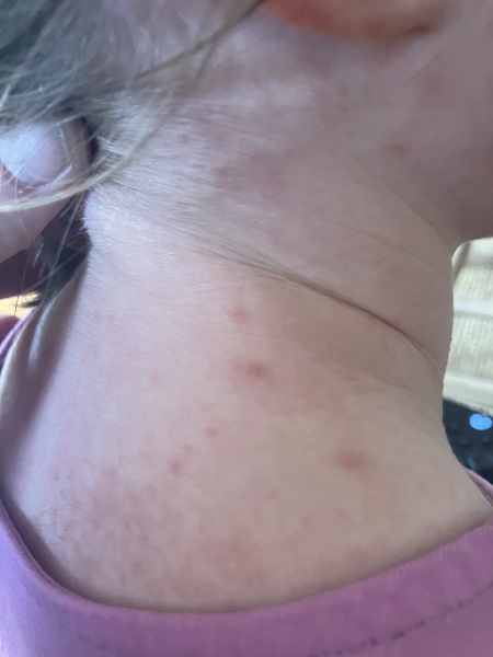 Bites on daughter