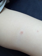 Chicken pox?