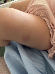 Large hard lump on toddler’s leg a month after 1 year jabs