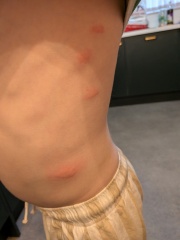 What could be causing these itchy red bites on my son?