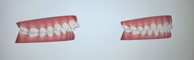 Do DC really need teeth removed for braces?