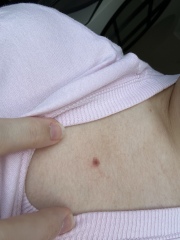 Potential melanoma