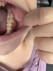 Mouth cancer?