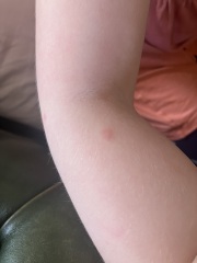Bites on daughter