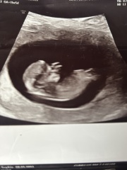 Can anyone help identify the nub in my early scan photos?