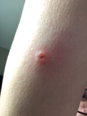 AIBU to ask whether these bites need checking by a doctor?