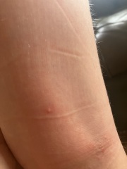 Bites on daughter